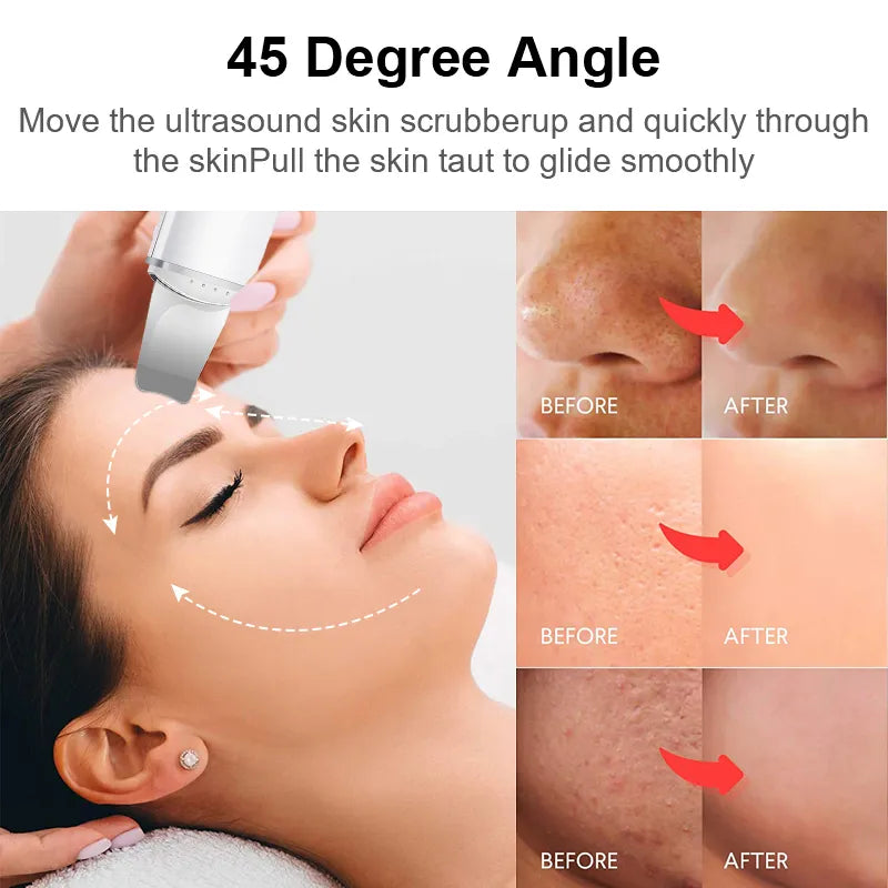 Ultrasonic Skin Scrubber, Vibration Face Spatula, Blackhead Remover Shovel Clean Cavitation Peeling Facial Lifting skin care